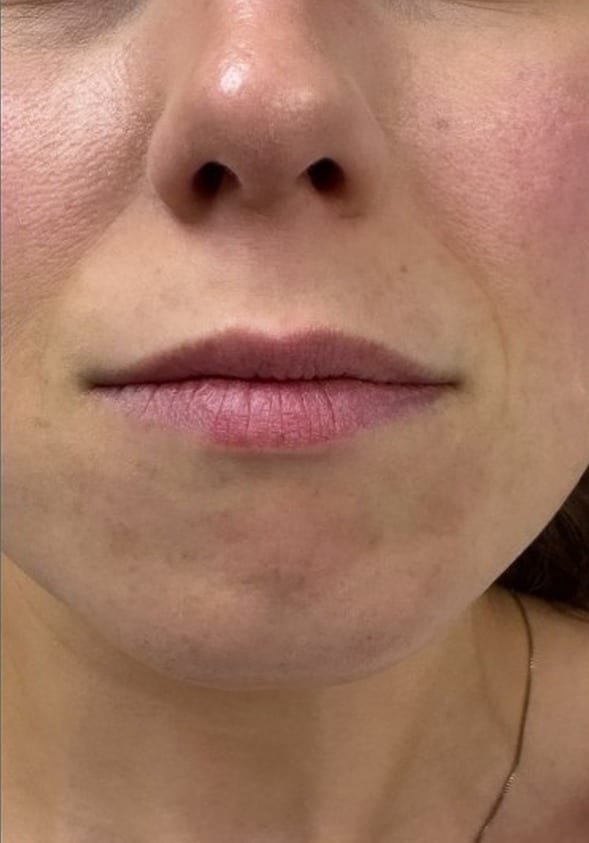 Lips before and after hyaluronic acid filler, front view