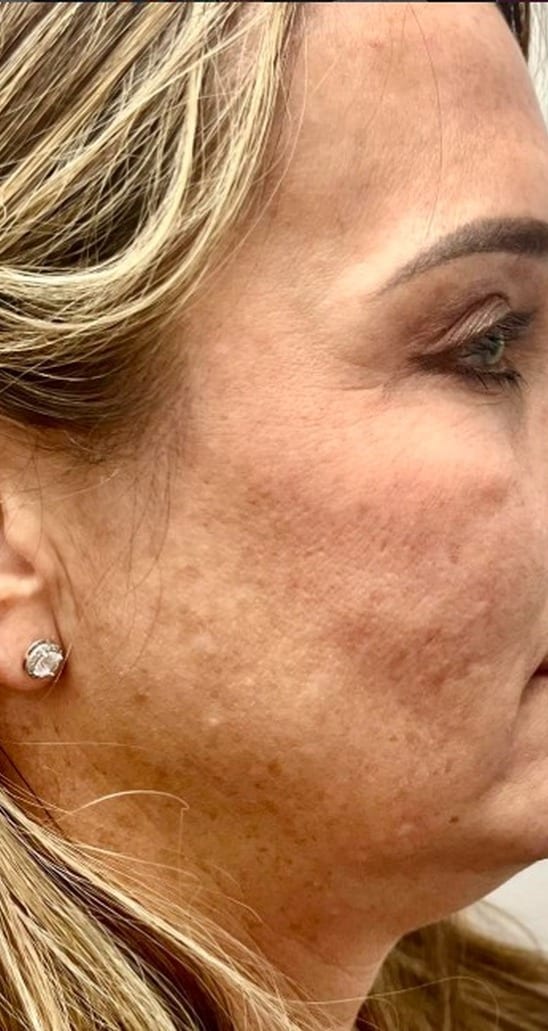 Cheek texture before and after Morpheus8 and IPL